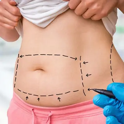 Tummy Tuck in Islamabad Pakistan