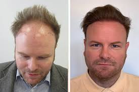 Hair Transplant in Rawalpindi Before and After