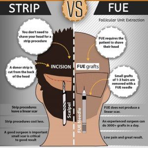 Difference Between FUE or FUT Hair Transplant