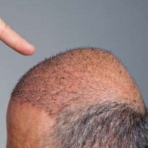 Side Effects of Hair Transplant Pakistan