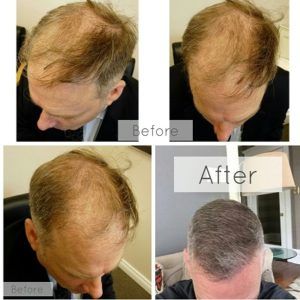 Things Done After a Hair Transplant Procedure