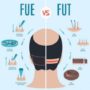 Which Type of Hair Transplant is Best For You?