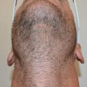 Why People Choose the Body Hair Transplantation?