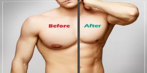 Gynecomastia Male Breast Reduction Cost Islamabad