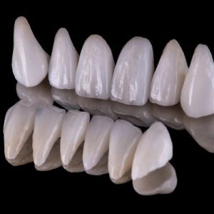 Dental Veneers Cost in Pakistan