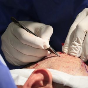 5000 grafts hair transplant cost in Pakistan