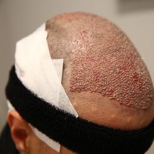 Can You Go Bald Again After a Hair Transplant?