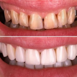 Dental Restorations