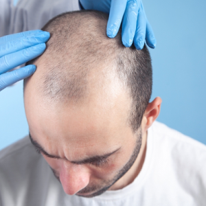 5 Steps of FUE Hair Transplant in Islamabad