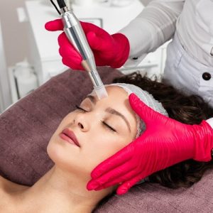 What is the right age for microneedling?