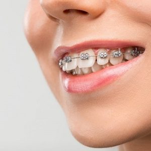 What type of dental braces are right for me?