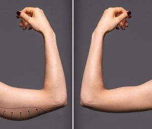 how much liposuction of arms cost in Islamabad