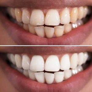 How much does laser whitening cost in Pakistan?