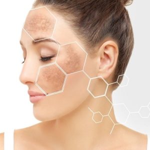 Is there any permanent cure for the removal of melasma?