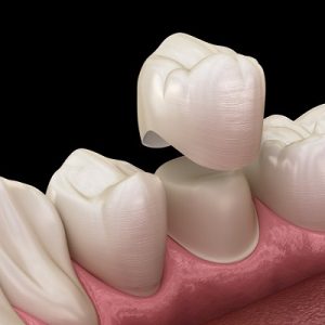 Why are tooth crowns often recommended?