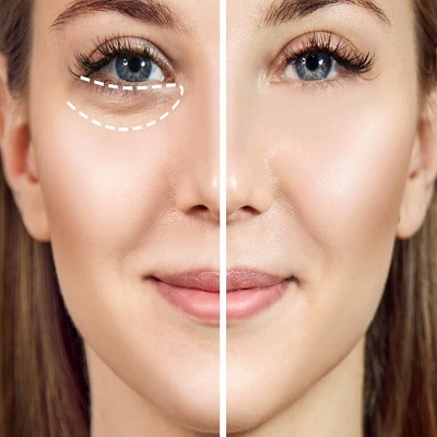 How Long Will It Take to Recover from Eye Bag Removal Surgery?