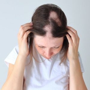 What is the cost of alopecia areata treatment in Pakistan?