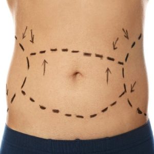 How much does tummy tuck surgery cost in Pakistan?