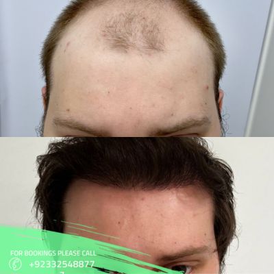 FUT hair transplant before after result
