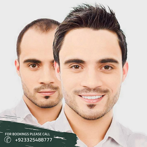 results of hair transplant Islamabad