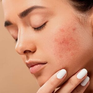 Combining Treatments for Maximum Acne Scar Reduction