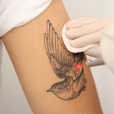Factors Affecting Laser Tattoo Removal Success Rates