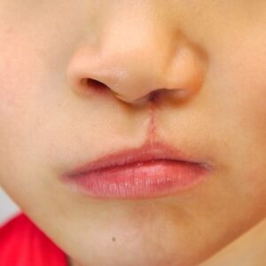 Understanding Cleft Lip and Palate: A Comprehensive Overview
