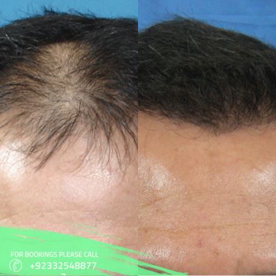 alopecia areata treatment cost in Islamabad