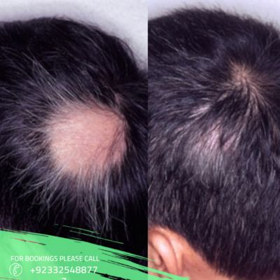 alopecia areata treatment in Islamabad