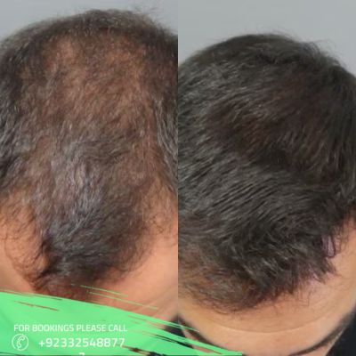 alopecia areata treatment before after result