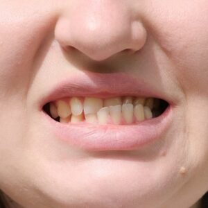 What Are the Causes and Solutions of Protruding Teeth
