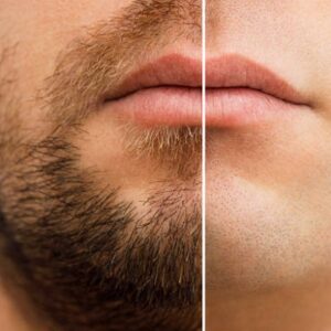 Is Beard Hair Transplant a Better Option for Me?