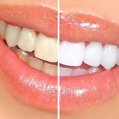 What's the best way to whiten your teeth?