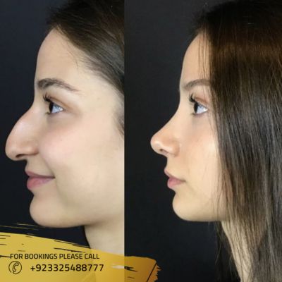 Before after of Magic facelift in Islamabad
