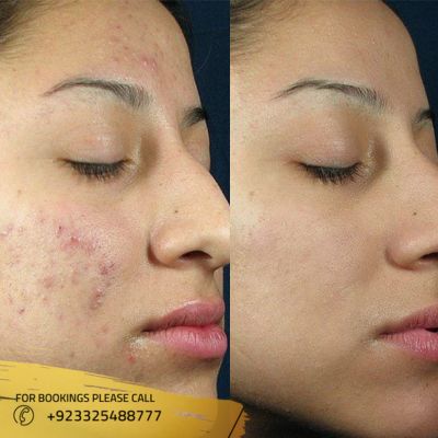 Before after of acne scar treatment in Islamabad