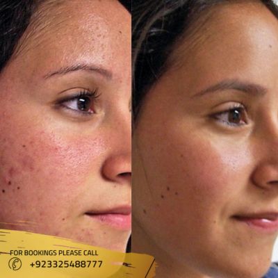 Before after of chemical skin peel treatment in Islamabad