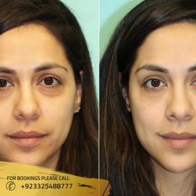 Before after of dark circles treatment in Islamabad