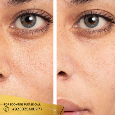 Before after of large pores treatment in Islamabad