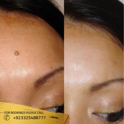 Before after of laser mole removal treatment in Islamabad