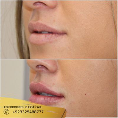 Before after of lip filler in Islamabad