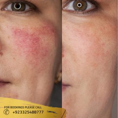 Before after of melasma treatment in Islamabad