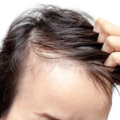 Does Scalp Micropigmentation Grow Hair?