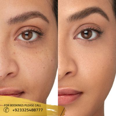 Images of Brow lift surgery in Islamabad