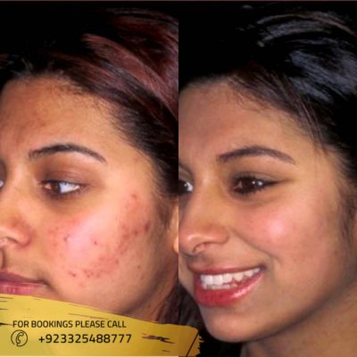 Images of acne scar treatment in Islamabad