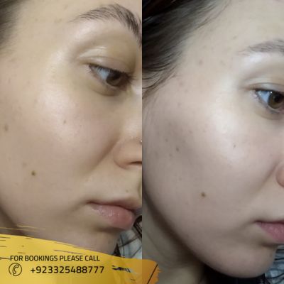 Images of chemical skin peel treatment in Islamabad