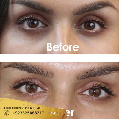 Images of dark circles treatment in Islamabad