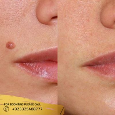 Images of laser mole removal treatment in Islamabad