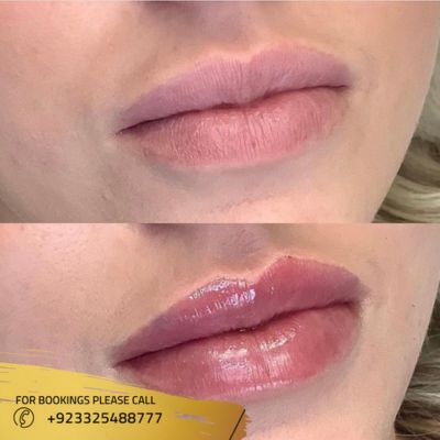Images of lip filler in Islamabad