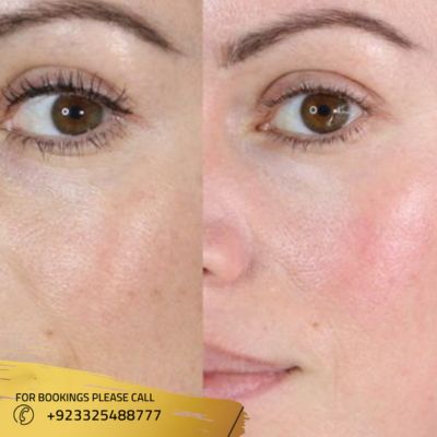 Result of chemical skin peel treatment in Islamabad