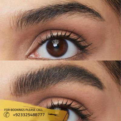 Results of Brow lift surgery in Islamabad